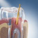 A Importância da Anatomia Interna no Sucesso Endodôntico 8 a importancia da anatomia interna no sucesso endodontico