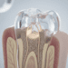 A Importância e os Objetivos da Obturação do Canal Radicular no Sucesso Endodôntico 8 a importancia e os objetivos da obturacao do canal radicular no sucesso endodontico