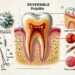 Pulpite Reversível: Sintomas, Causas, Diagnóstico e Tratamento para Preservar a Saúde Dental 8 Pulpite Reversível: Sintomas, Causas, Diagnóstico e Tratamento para Preservar a Saúde Dental