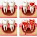 Abscessos dentários: causas, sintomas, tratamentos e prevenção para manter sua saúde bucal em dia