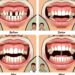 Fechamento de Diastemas: Técnicas, Benefícios e Cuidados Essenciais para um Sorriso Perfeito