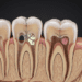 Fatores Etiológicos dos Fracassos em Tratamentos Endodônticos 8 fatores etiologicos dos fracassos em tratamentos endodonticos