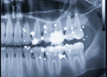 identificacao e consequencias do twinkle em radiografias periapicais