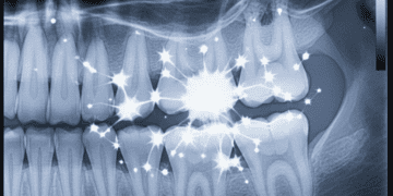 identificacao e consequencias do twinkle em radiografias periapicais