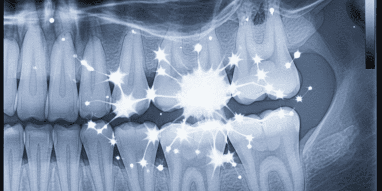 identificacao e consequencias do twinkle em radiografias periapicais