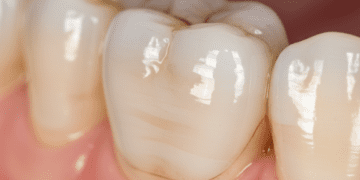 impacto da restauracao coronaria no sucesso endodontico