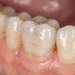 Impacto da Restauração Coronária no Sucesso Endodôntico 8 impacto da restauracao coronaria no sucesso endodontico