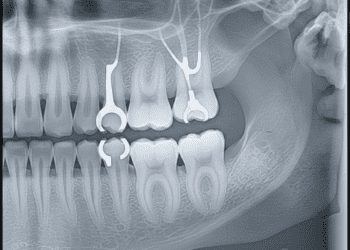 impacto radiografico de proteses parciais removiveis ppr na odontologia