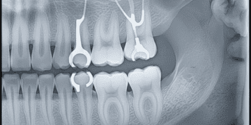 impacto radiografico de proteses parciais removiveis ppr na odontologia