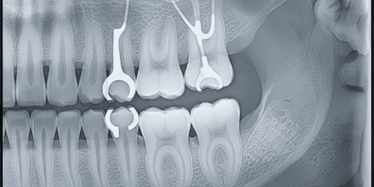 impacto radiografico de proteses parciais removiveis ppr na odontologia