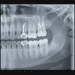 impacto radiografico de proteses parciais removiveis ppr na odontologia