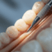 Manobras Complementares para a Técnica de Obturação Endodôntica 8 manobras complementares para a tecnica de obturacao endodontica