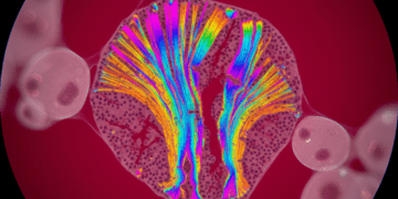microscopia de polarizacao na citologia analise de estruturas birrefringentes