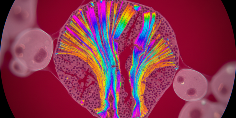 microscopia de polarizacao na citologia analise de estruturas birrefringentes