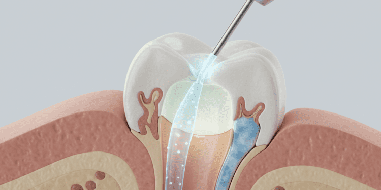 Protocolos de Irrigação, Biocompatibilidade e Prognóstico Endodôntico: O Caminho para o Sucesso do Tratamento 1 protocolos de irrigacao biocompatibilidade e prognostico endodontico