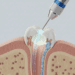 Protocolos de Irrigação, Biocompatibilidade e Prognóstico Endodôntico: O Caminho para o Sucesso do Tratamento 8 protocolos de irrigacao biocompatibilidade e prognostico endodontico