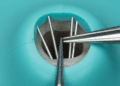 remocao de cones de prata em retratamento endodontico