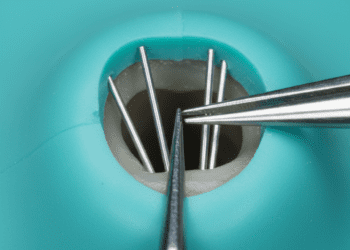 remocao de cones de prata em retratamento endodontico