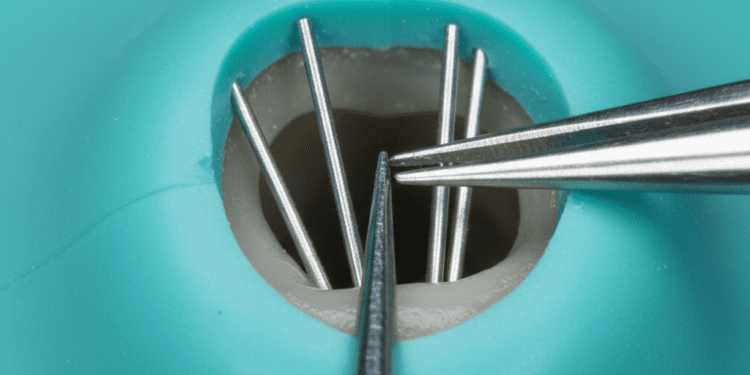 remocao de cones de prata em retratamento endodontico