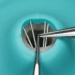 remocao de cones de prata em retratamento endodontico