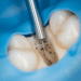 remocao de pastas e cimentos em retratamento endodontico