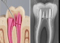 tecnica de condensacao lateral de guta percha aplicacao e aspectos radiograficos