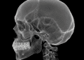 telerradiografia e cefalometria cranio em perfil